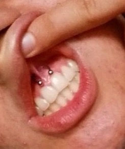 Smiley Piercing