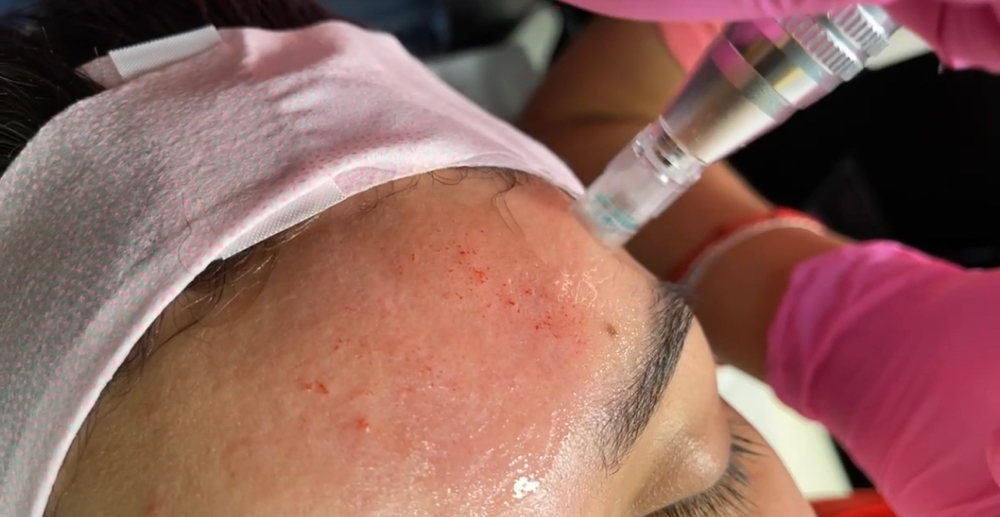 Microneedling