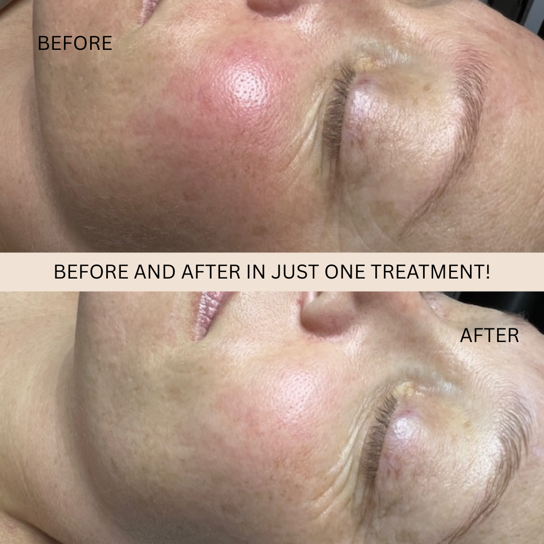 Renew Epidermal Treatment