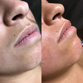 Lip waxing
