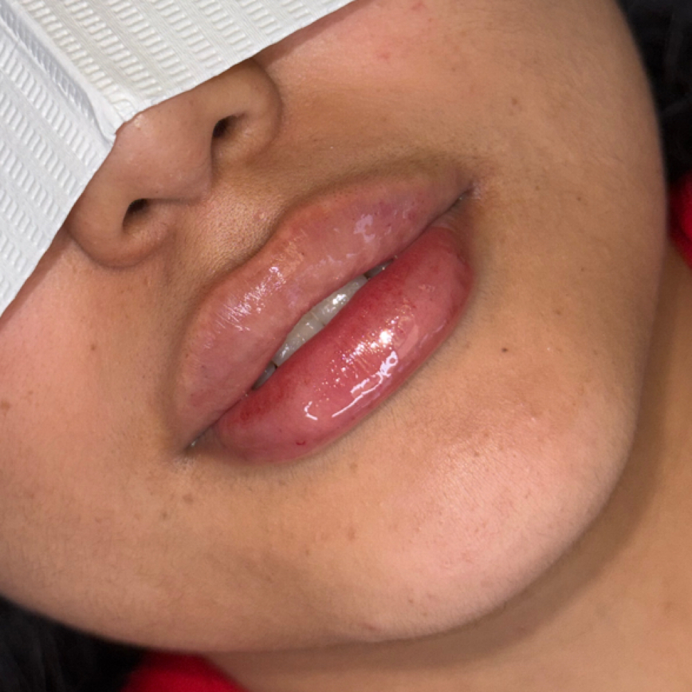 Lip Flip at Aether Aesthetics in Midland, TX