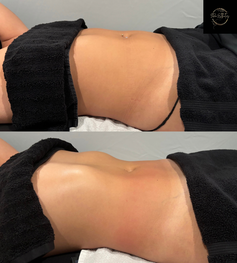 Body Sculpt-Abdomen (1 Session)