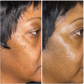 Plasma - DPN Removal