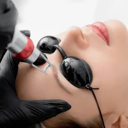 🫟Tattoo Removal
