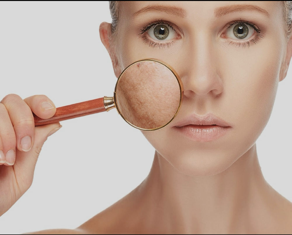 Peeling Para Manchas (Grado Medico) at Dream Body Esthetic in Orlando, FL