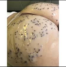 Backcial & Cheeky Treatment (Back & Full Glute Facial)