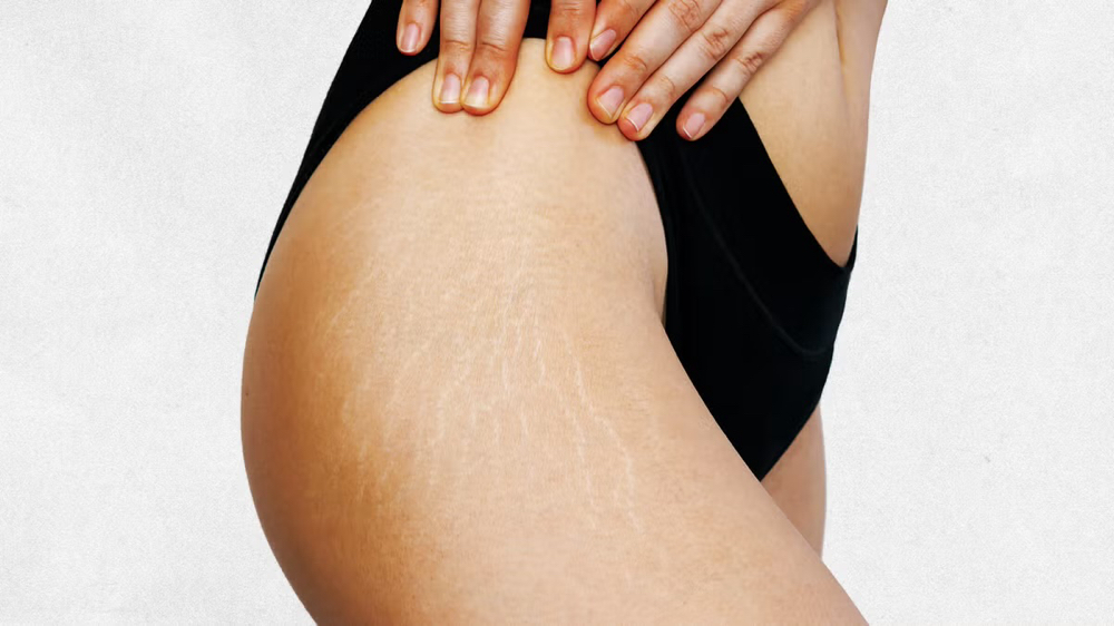 Stretch Mark Chemical Peel Package