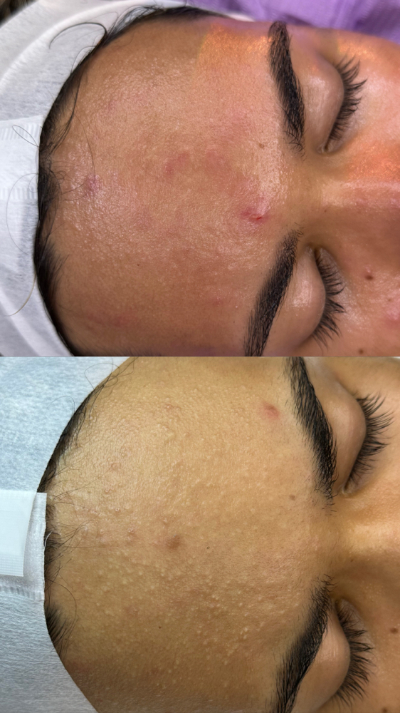 Tratamiento Acné/Acne Treatment at YubyRo in San Juan, PR
