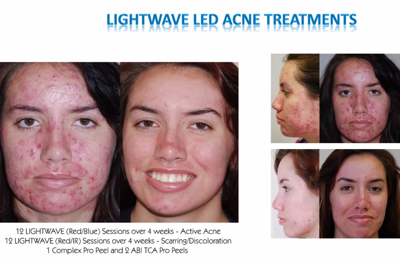 Lightwave ACNE Treatment