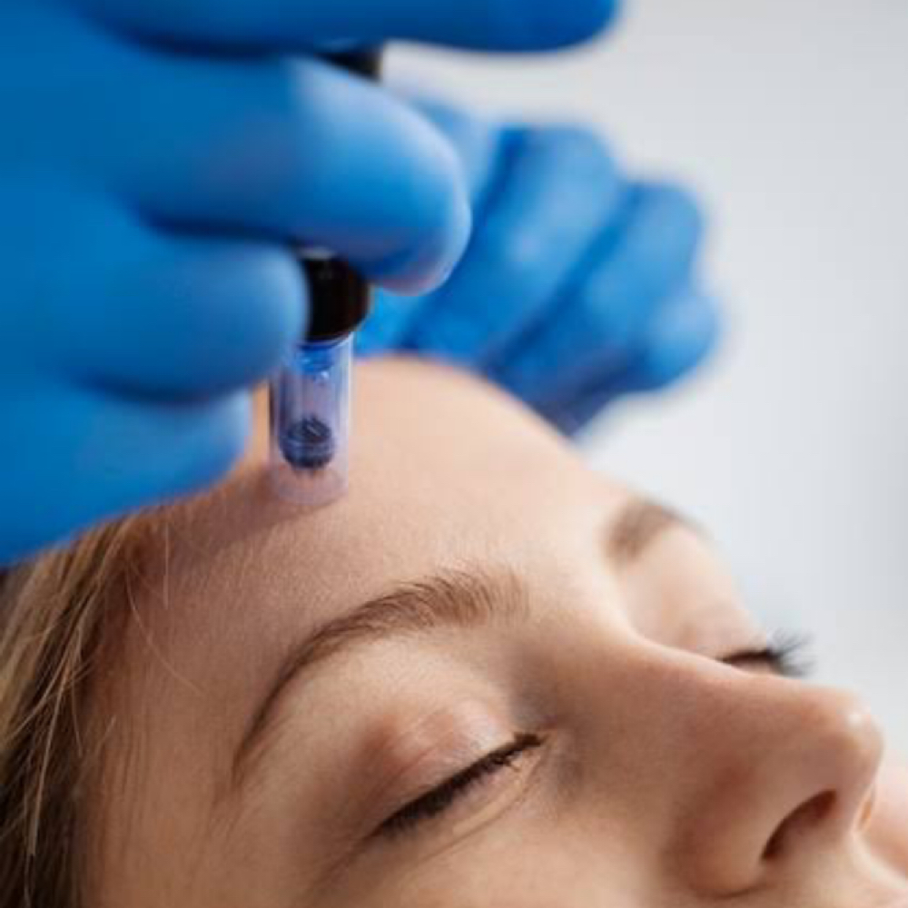 Collagen Induction + Dermaplane at Orion Beauty in Cincinnati, OH