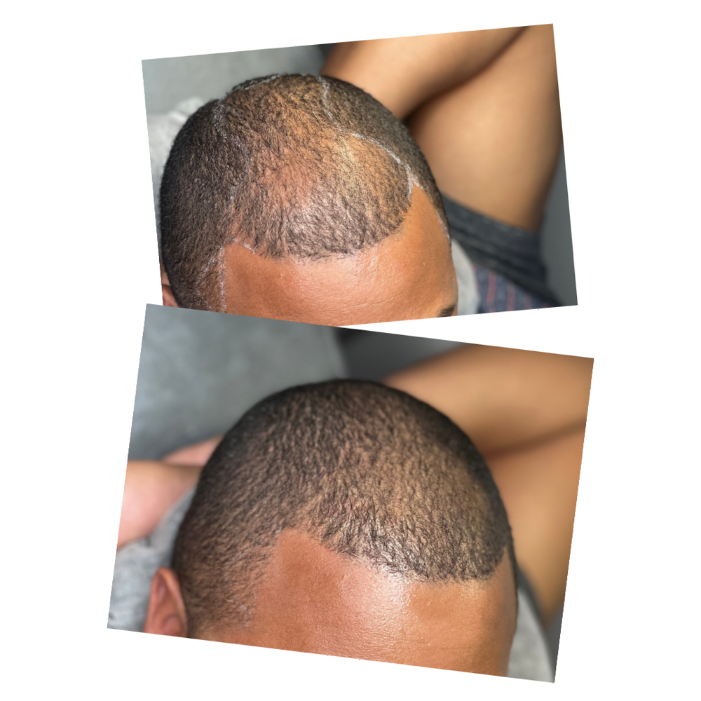 Scalp Micropigmentation