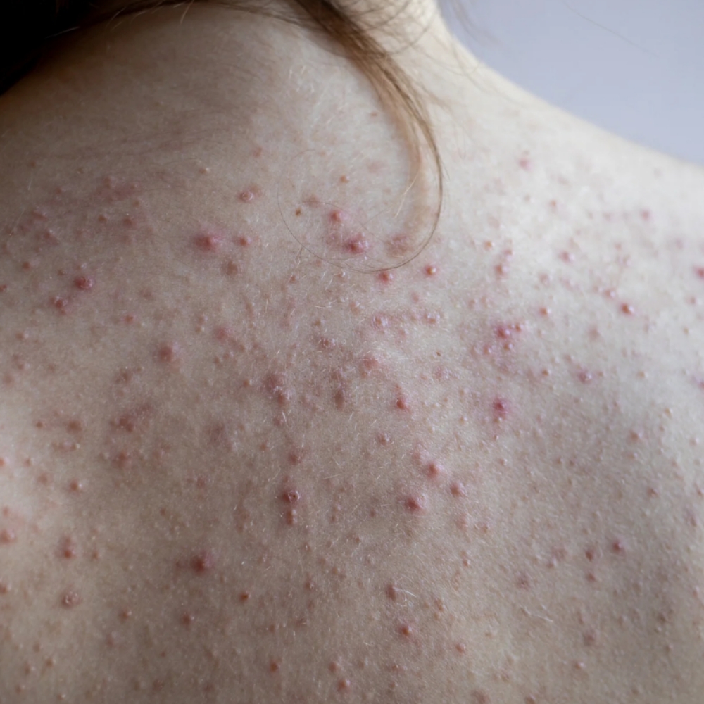 Back Acne Peel at Angel Face Skin Care in Madera, CA