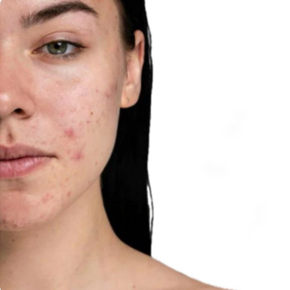 ACNE RELIEF CONSULT at AESTHETICSBYNATALY in Alhambra, CA