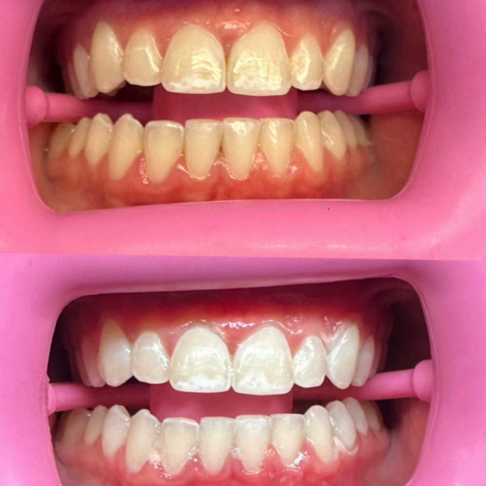 Teeth Whitening at Magnolia Artistry in Draper, UT