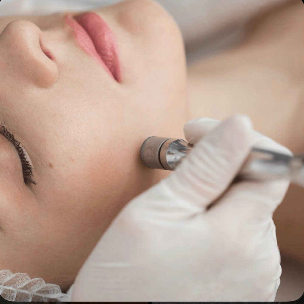 Add on Micro dermabrasion at Bella Rose Skincare & Beauty by Heather in Stuart, FL