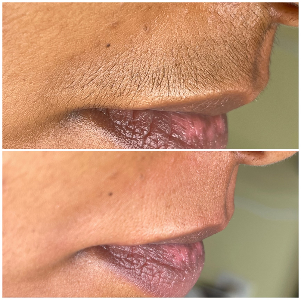 Upper Lip
