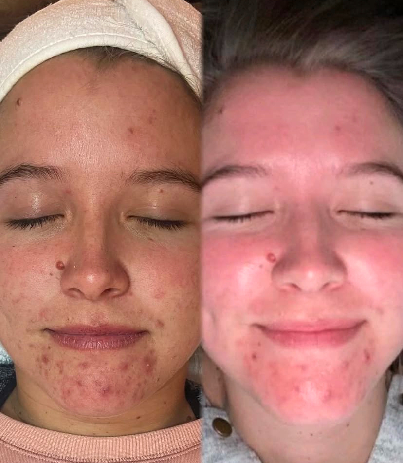 MAD Non-Peel Chemical Peel