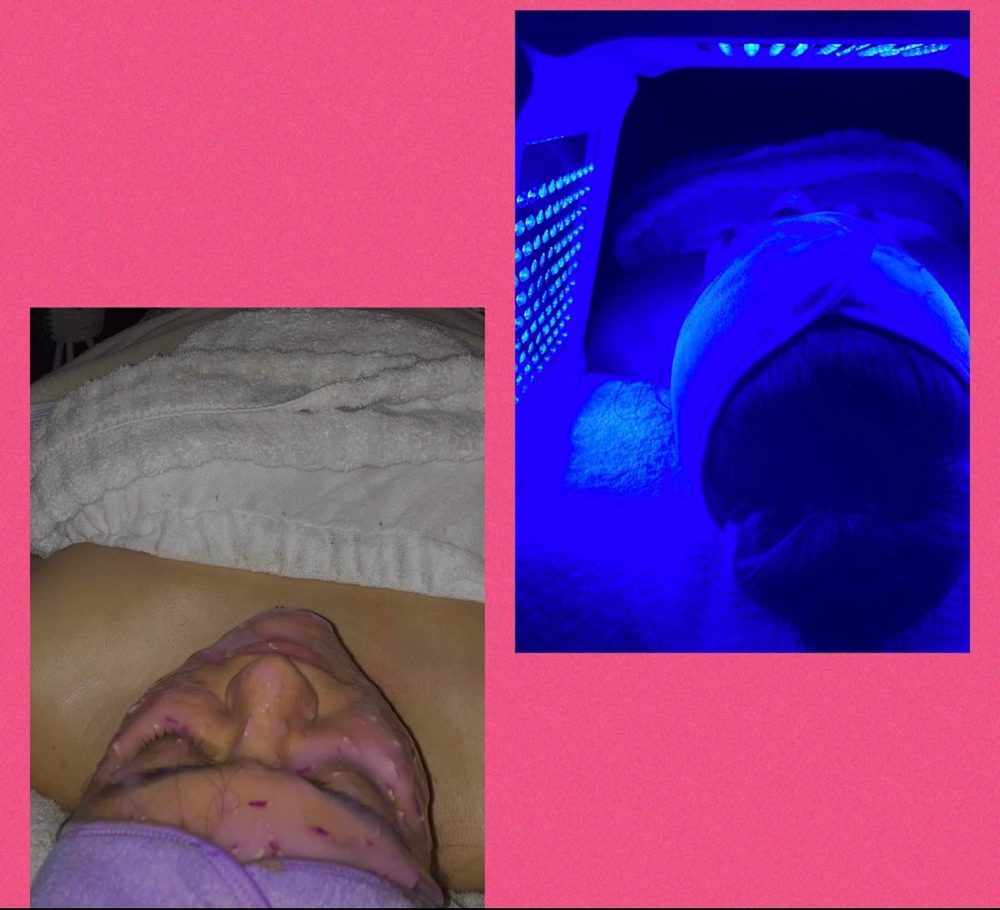 Acne Treatment