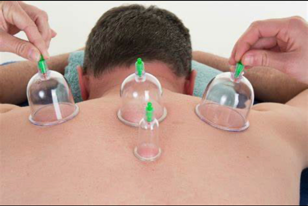 Cupping therapy