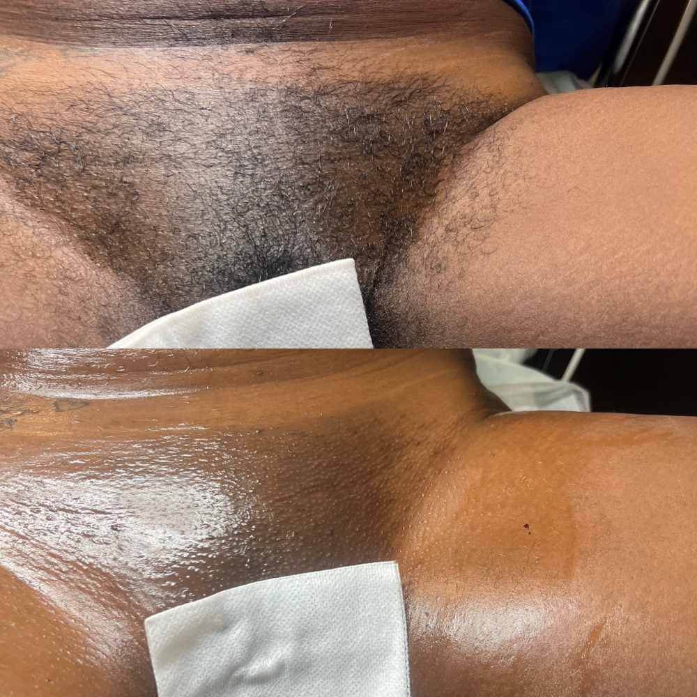 Brazilian Wax at HVS BODY in Shaker Hts, OH