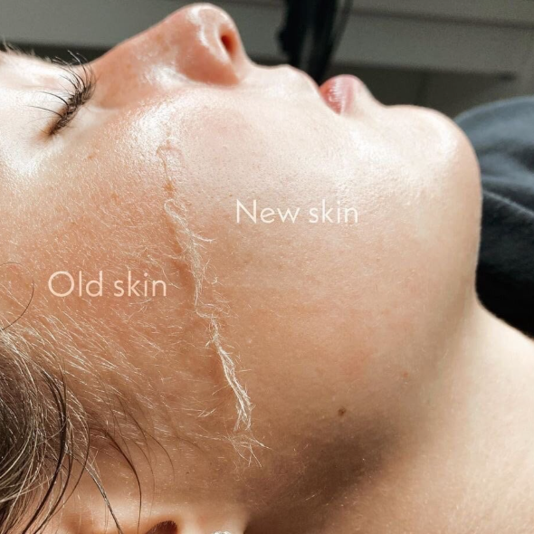 Dermaplane Luxe Facial at Serenity Skin Studio in Wichita, KS