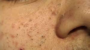 Teen (Acne) Facial (45-60min)