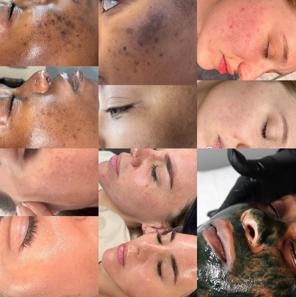 Green Sea Peel Liquid Microneedling