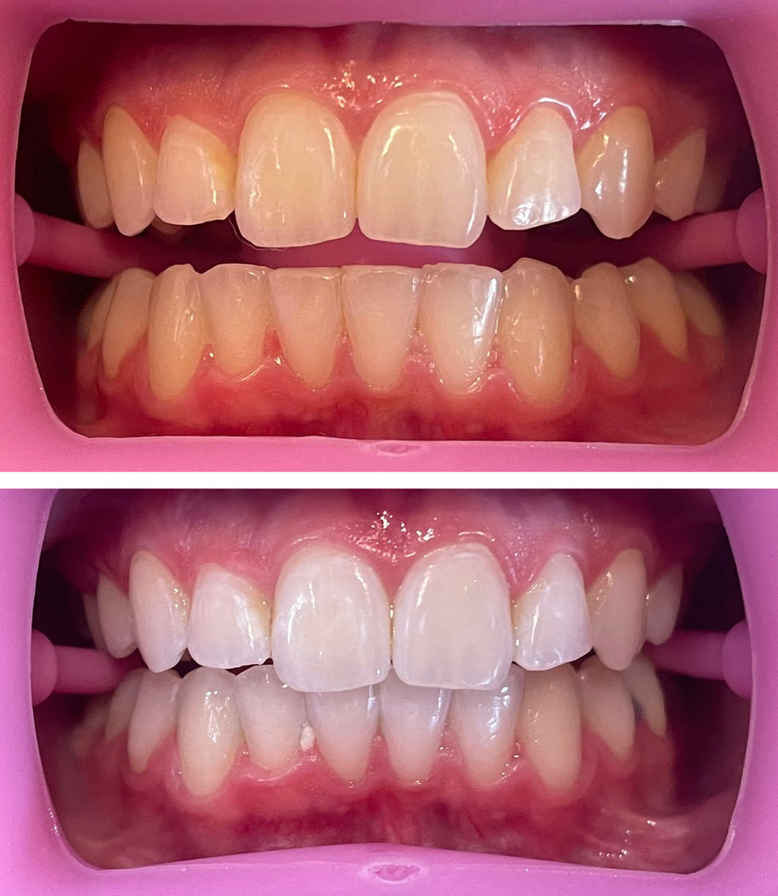 Cosmetic Teeth Whitening