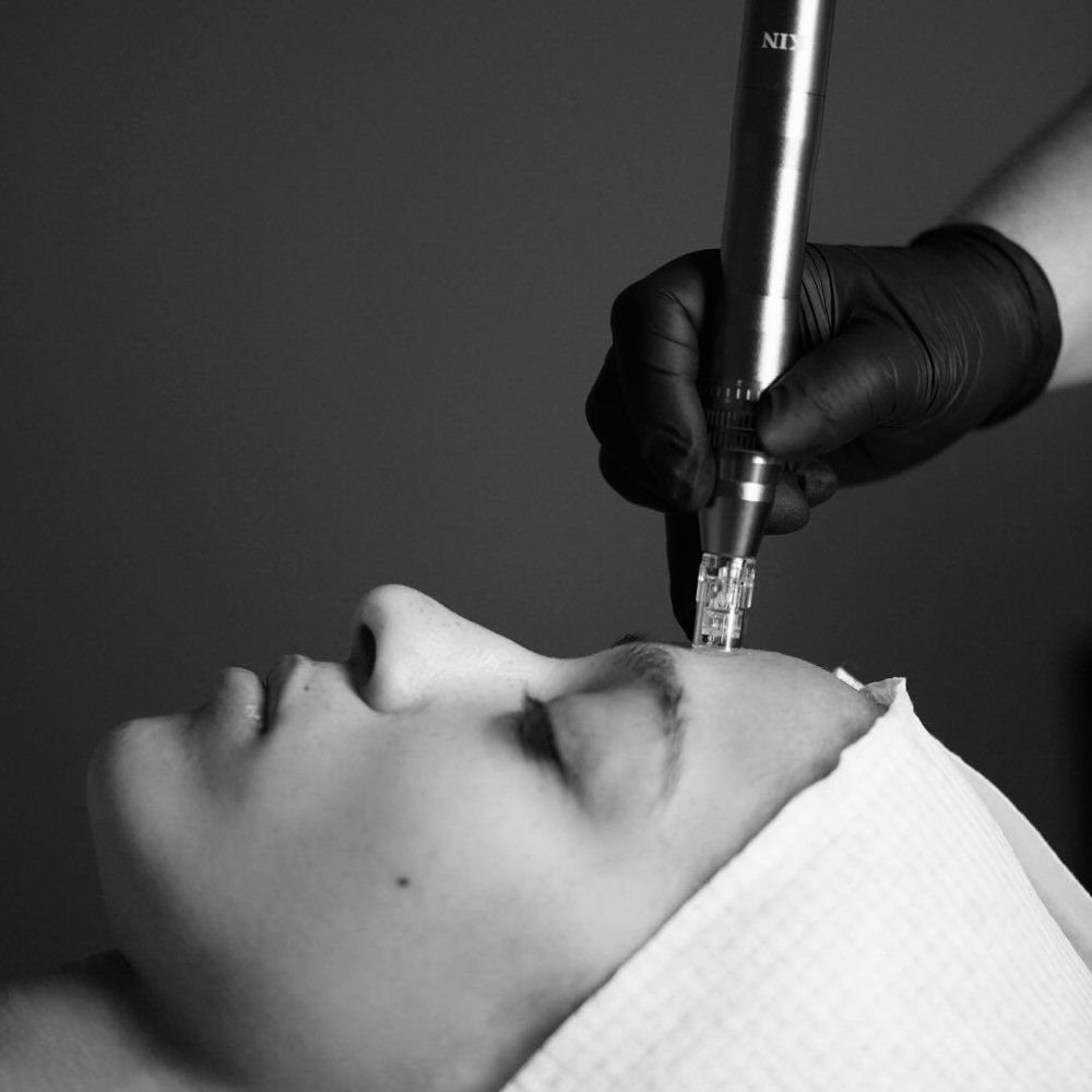 Microneedling