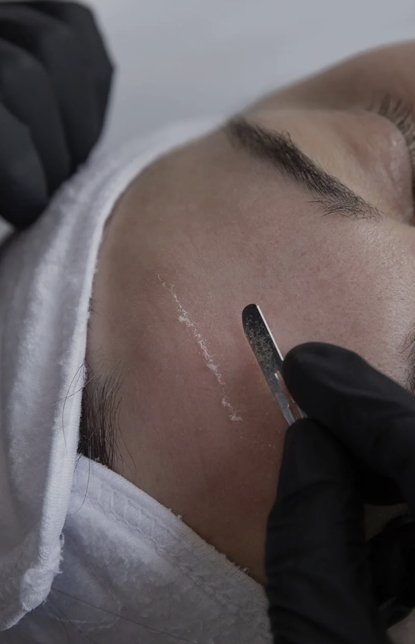 Dermaplaning