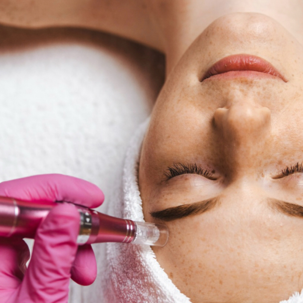 Microneedling Advanced at Marta Rabelo Skin & Laser in Malden, MA