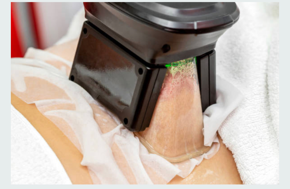 Cryolipolysis