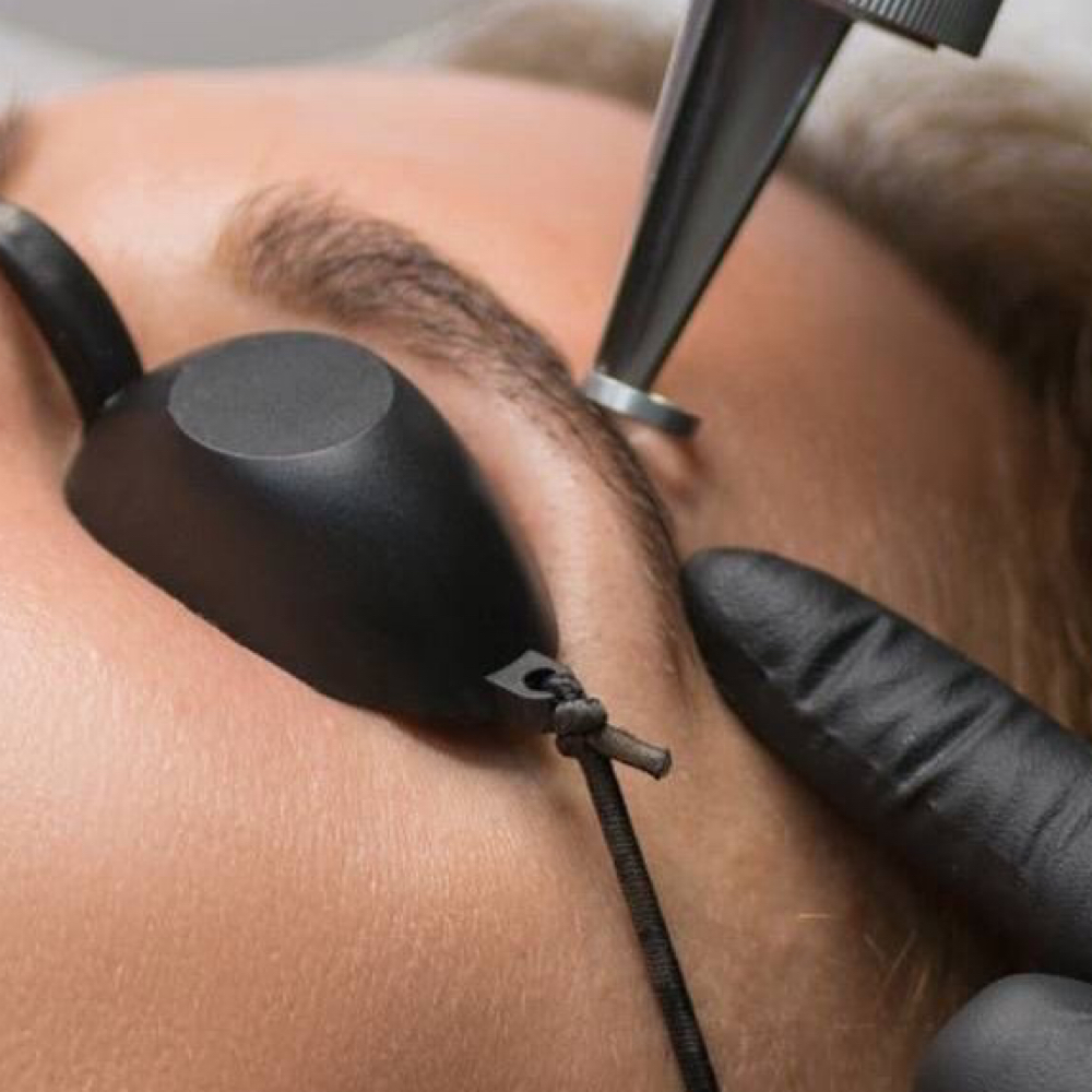 Laser Removal at Ana Santos Beauty in Saugus, MA