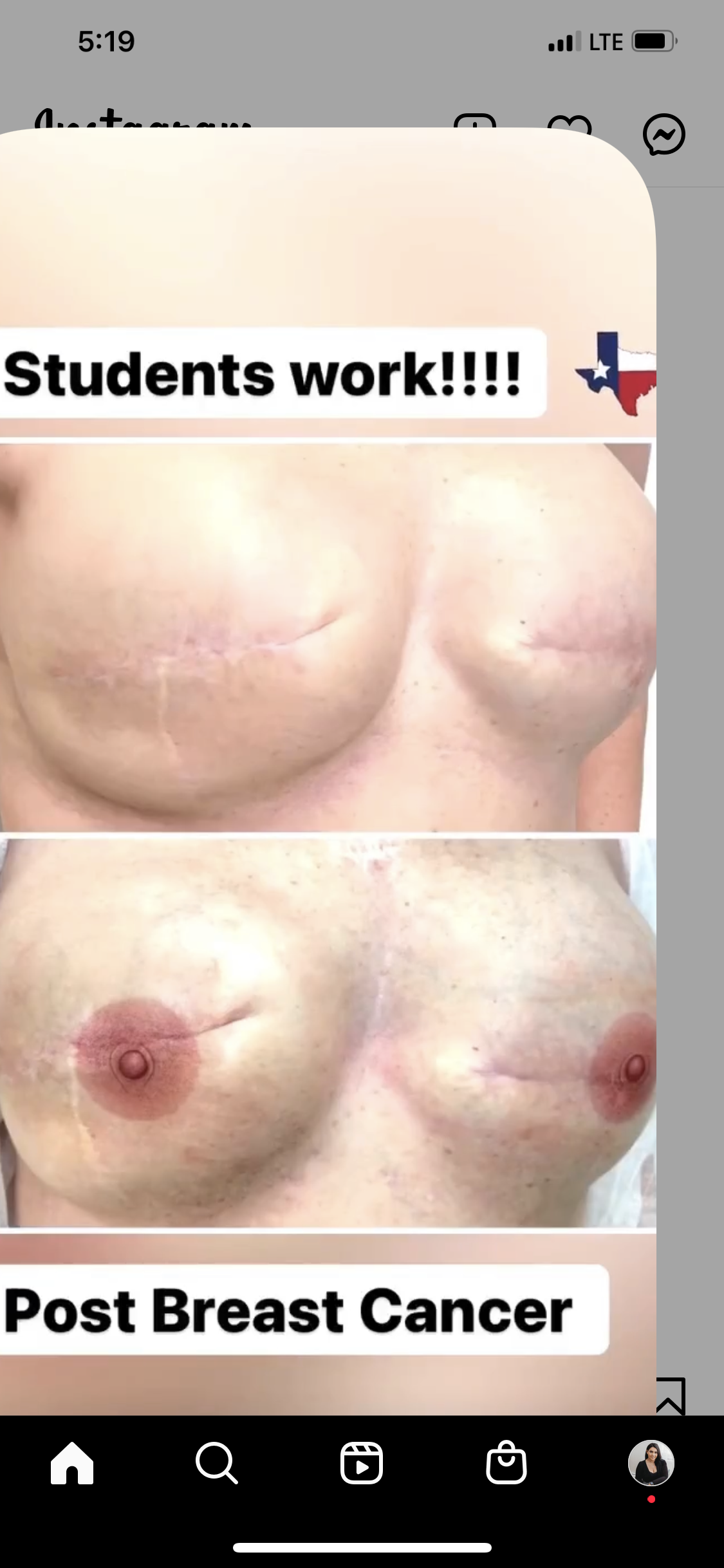3D AREOLA TATTOO/SINGLE BREAST