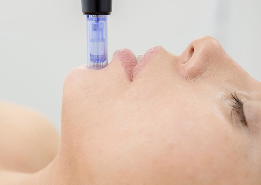 MICRONEEDLING/NANO FACIAL