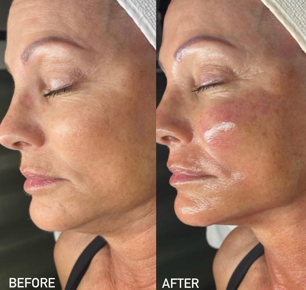 BioRePeel Chemical Peel