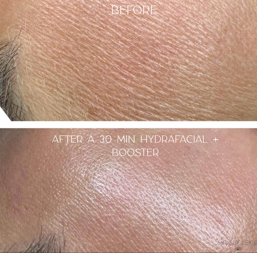HydraFacial 🪄