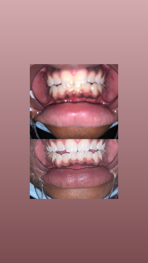 teeth whitening 30mins at RJ Cosmetics in PONTOTOC, MS