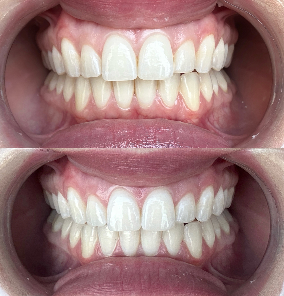 Teeth Whitening Refresher at Serene Studios in Sigel, IL