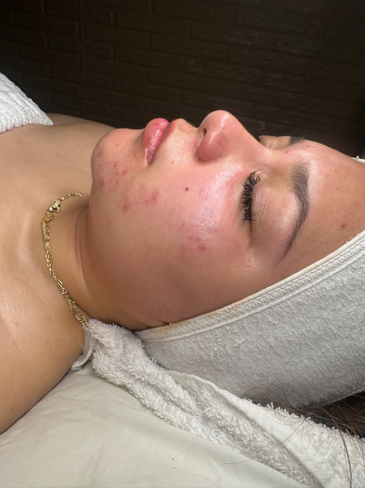 ACNE FACIAL at CFlo Esthetics in Stafford, VA
