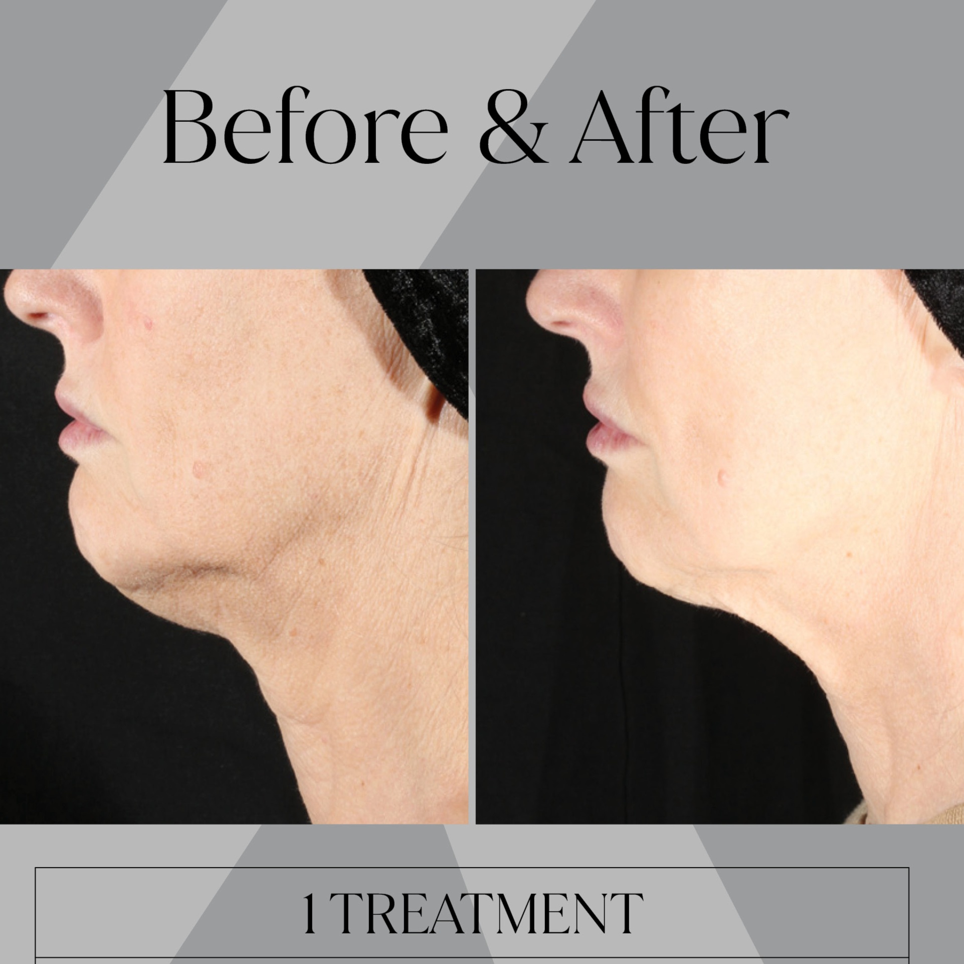 XERF Skin Tightening at Karisma Esthetics in Melbourne, FL