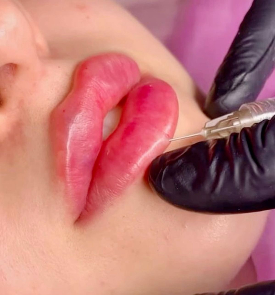 Russian Lip (2.2ml) HA
