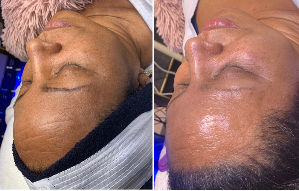 HydraFacial Plus (Anti-Aging) at Beauty Therapy by Chanel in Tucker, GA