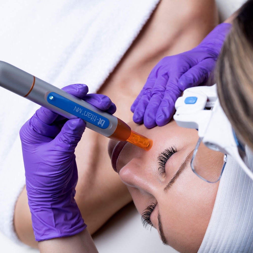 BT-titan® MN Nano needling