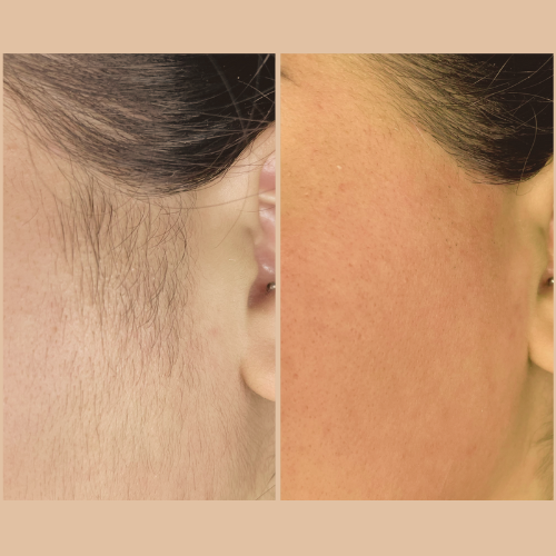 Side Burn