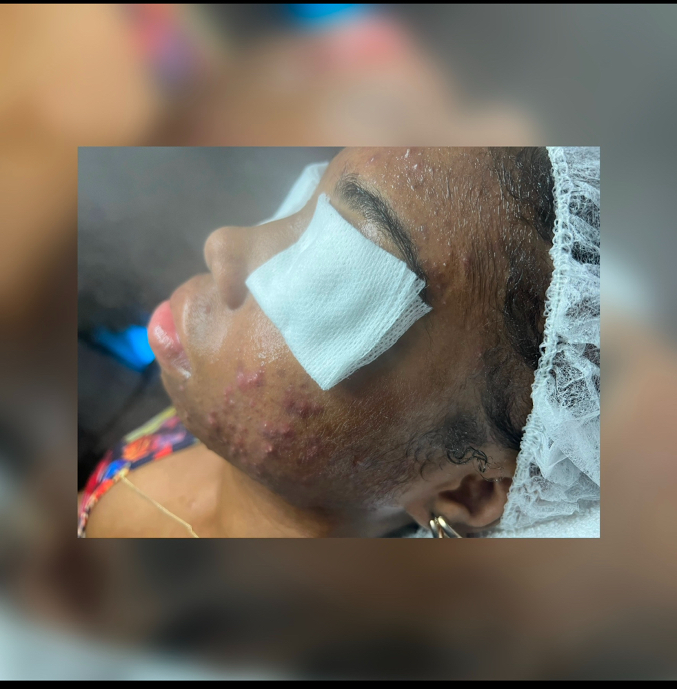 BID Custom Acne Fighting Facial