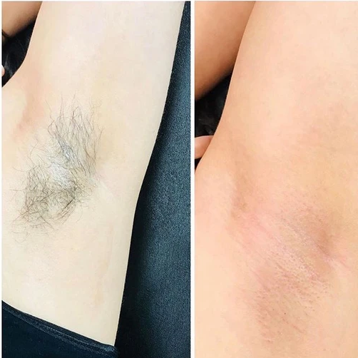 Waxing - Underarms