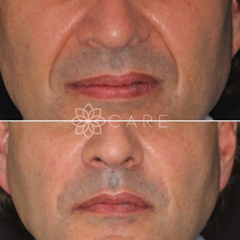 Bio-Filler Injections at ReGenerations Medi Spa in Radcliff, KY