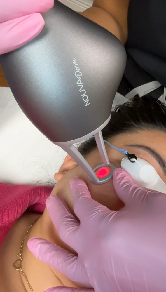 Nouvaderm Laser Resurfacing