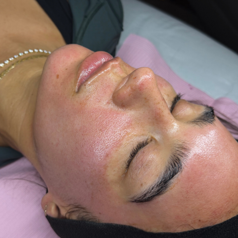Standard Micro-Needling at HP Skin Bar in Durham, NC